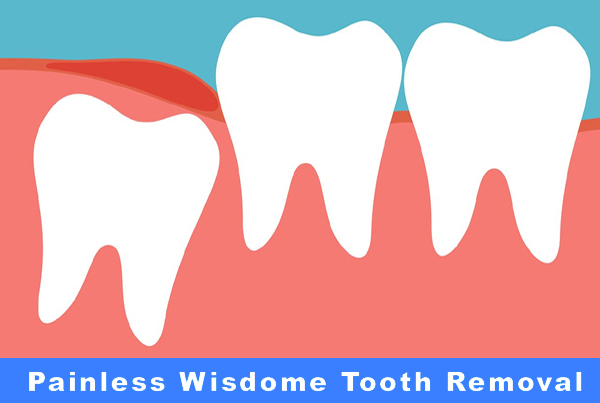 Painless Wisdom Tooth Removal